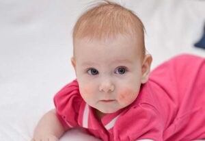 آلرژی در تغدیه نوزاد 