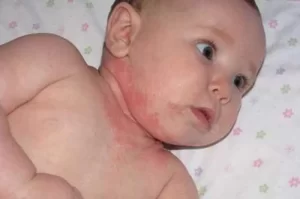 آلرژی غذایی نوزاد 